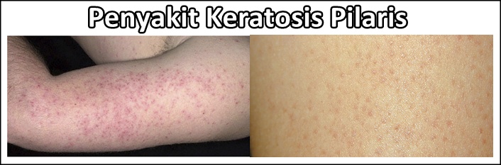 Obat Tradisional Keratosis Pilaris