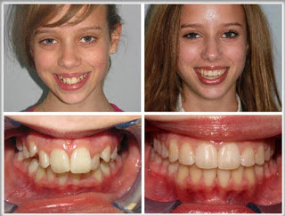Các phương pháp niềng răng trẻ em phổ biến