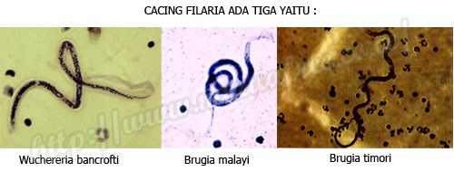 Apa Itu Penyakit Filariasis 