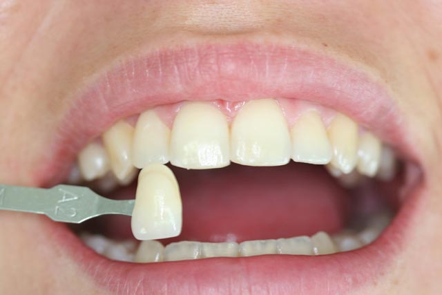 Diseño de sonrisa con carillas dentales: 9 preguntas frecuentes (Odontología)