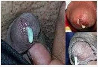 Obat kencing nanah malaysia, cara mengobati kemaluan mengeluarkan nanah, obat kencing nanah yg tersedia di apotik, mengobati penyakit sipilis secara alami, fungsi obat gonore (kencing nanah), penyebab penyakit gonorrhea adalah, obat gonore (kemaluan bernanah) wanita, kencing nanah dan berdarah, penyakit sipilis lelaki, kenapa kemaluan lelaki bernanah, penyebab penyakit gonore dan cara pencegahannya