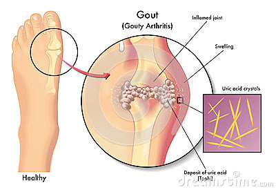 obat asam urat saat menyusui