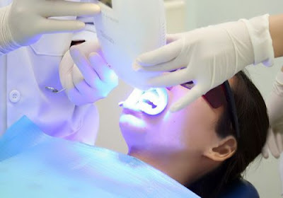  Tẩy trắng răng bằng Laser Whitening có hại không?