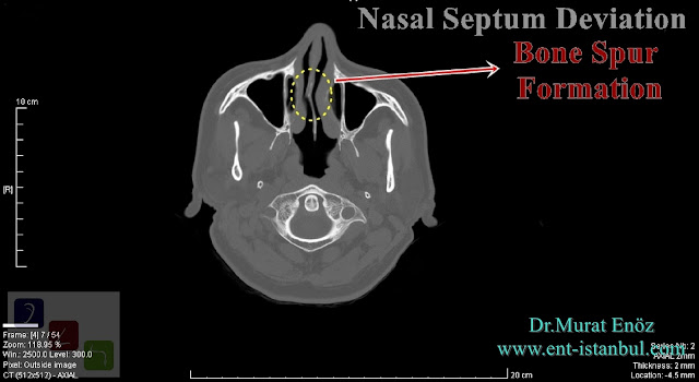 Nasal Septum Deviation - Bone Spur Formation