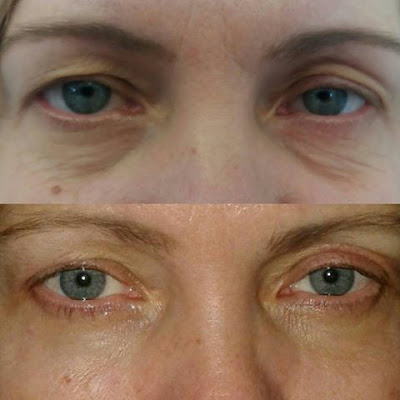 Foto del prima e del dopo l'intervento di Blefaroplastica