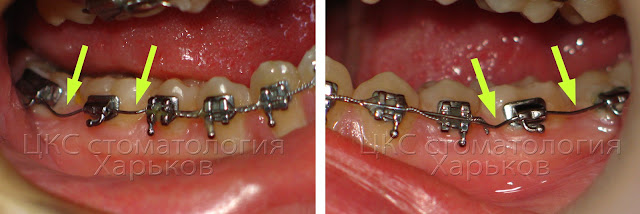 Признаки будущего отклеивания брекетов