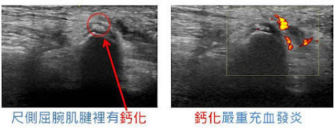 #鈣化性肌腱炎 #肌腱鈣化 #肩膀痛 #肩膀鈣化 ##鈣化性肌腱炎 震波 #超音波導引抽吸 #鈣化性肌腱炎 PRP #李嘉瑋醫師