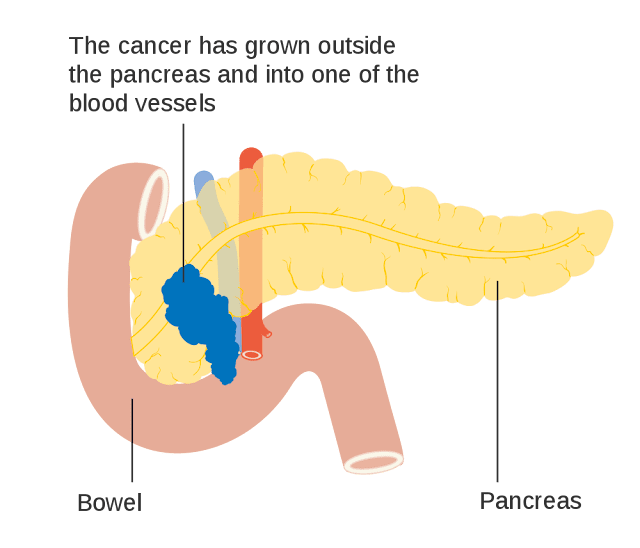 what-causes-pancreatic-cancer
