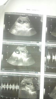 Surpresa, gravida de gêmeos!!! 