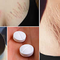 Remove Stretchmarks From Abdomen And Chest By Using These Methods!