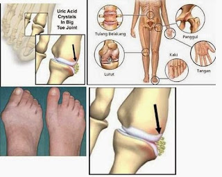 Asam urat rematik dan kolesterol, asam urat tinggi tanpa gejala, penyakit asam urat bisa sembuh, gejala asam urat.com, asam urat tinggi dan pengobatannya, asam urat normal untuk wanita dewasa, susu coklat asam urat, asam urat disebabkan, terapi untuk penyakit asam urat, obat asam urat alami yang ampuh, obat herbal asam urat tcu