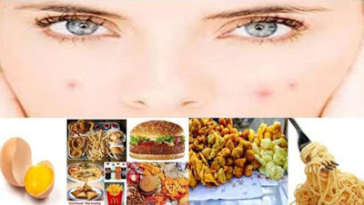 Food Causes Acne On Face You Need To Avoid