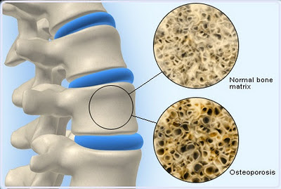 OsteMatrix Shaklee