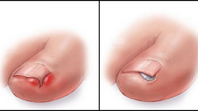 Share Kepada Temanmu ya! INILAH Cara Sangat Mudah Mengatasi Cantengan pada Kuku Kaki yang Sakitnya Luar Biasa!