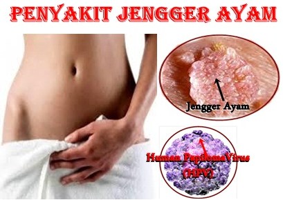 Penyakit Candyloma