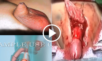 Penile reconstruction repair of small penis as in webbed penis or pensrotal fusion