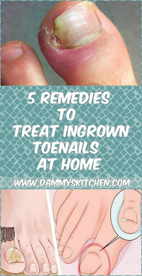 5 Remedies To Treat Ingrown Toenails At Home