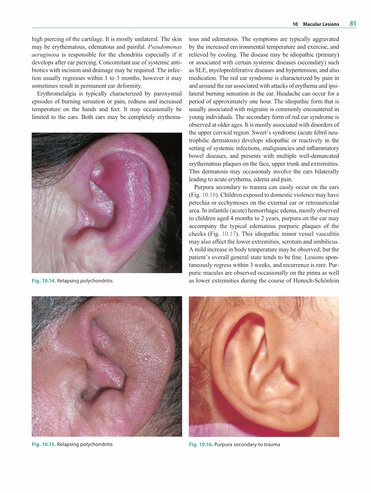 Railroad Track Ears Vs Normal Ears Otolaryngology by alexandros g 