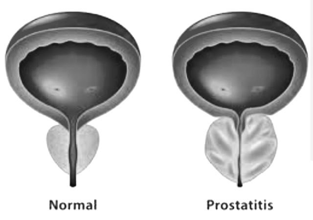 Prostate cancer, its symptoms and treatment
