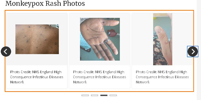 Monkeypox Pictures, Mokeypox Photos