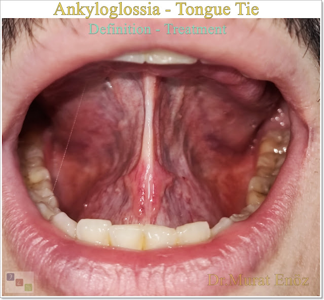 Tongue tie release surgery,Hypertrophic Lingual Frenulum, Ankyloglossia