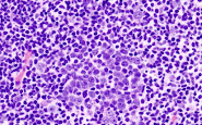 Diffuse Large B Cell Lymphoma Staging (DLBCL)