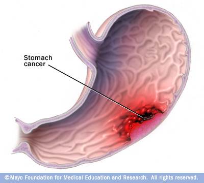 Towards health for all: Cancer may affect the people in daily life