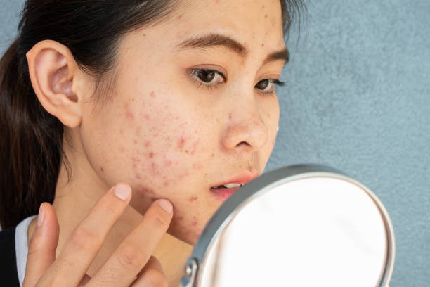 Acne and Pimples: Causes Treatment, Tips and 22 Remedies to treat Acne and Acne Scars.