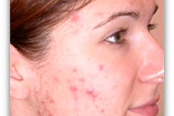 Bekas Nanah (Acne Scar)