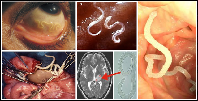 Mulai Sekarang Berhenti Konsumsi Makanan Ini !! Berbahaya, Karena Cacing Dapat Tumbuh di Dalam Tubuh Anda...