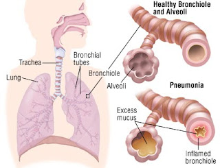 Nursing Care Plan Impaired Gas Exchange related to Pneumonia