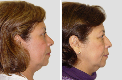 Rhinoplasty in NY