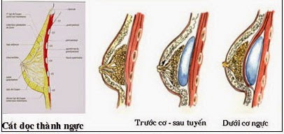 Nâng ngực nội soi túi Natrelle Inspira công nghệ mới 2