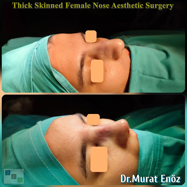 female nose asthetic surgery