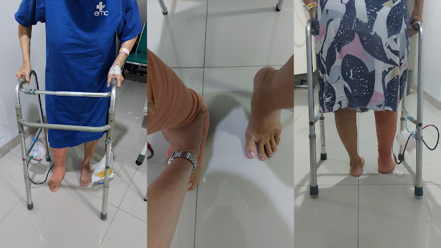 Masa Pemulihan Pasca Operasi Ganti Sendi Lutut