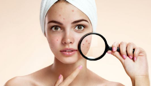 Difference between acne and blackheads