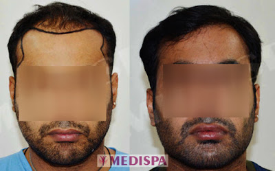 hair transplant in India