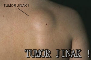 Obat Tumor ini AMPUH Menyembuhkan Semua Jenis Tumor Secara Alami