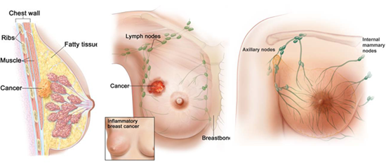 Cara pengobatan kanker payudara menggunakan daun sirsak, biaya pengobatan kanker payudara di penang, kanker payudara stadium 4 apa bisa disembuhkan, obat herbal kanker payudara tanpa operasi, cara penyembuhan kanker payudara stadium 3, pengobatan kanker payudara stadium 0, kanker payudara stadium 1 sampai 4, kanker payudara yaitu, obat kimia kanker payudara, obat herbal untuk mencegah kanker payudara, pengobatan kanker payudara setelah kemoterapi