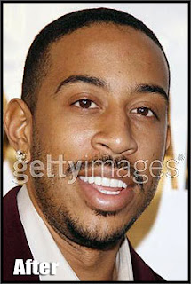 ludacris new teeth