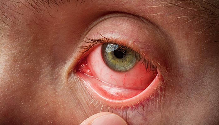 eye-conjunctivitis-or-pink-eye-symptoms-and-treatment-