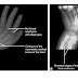 X-Rays of Upper limb