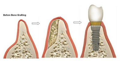 Ghép răng implant cho những trường hợp nào
