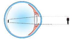 Myopic Refraction