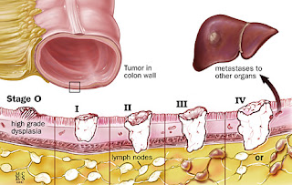 Types Of Most Common Cancer,Early Skin Cancer,Primary Liver Cancer,Most Common Cancer Types