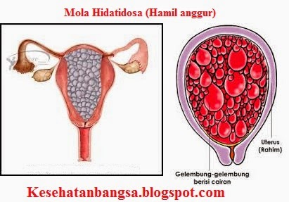 Makalah Mola Hidatidosa - CINTA ILMU KESEHATAN