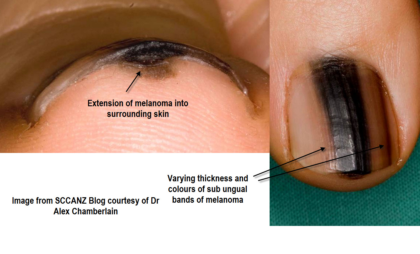 87 Nail Melanoma Images, Stock Photos, 3D objects, & Vectors | Shutterstock