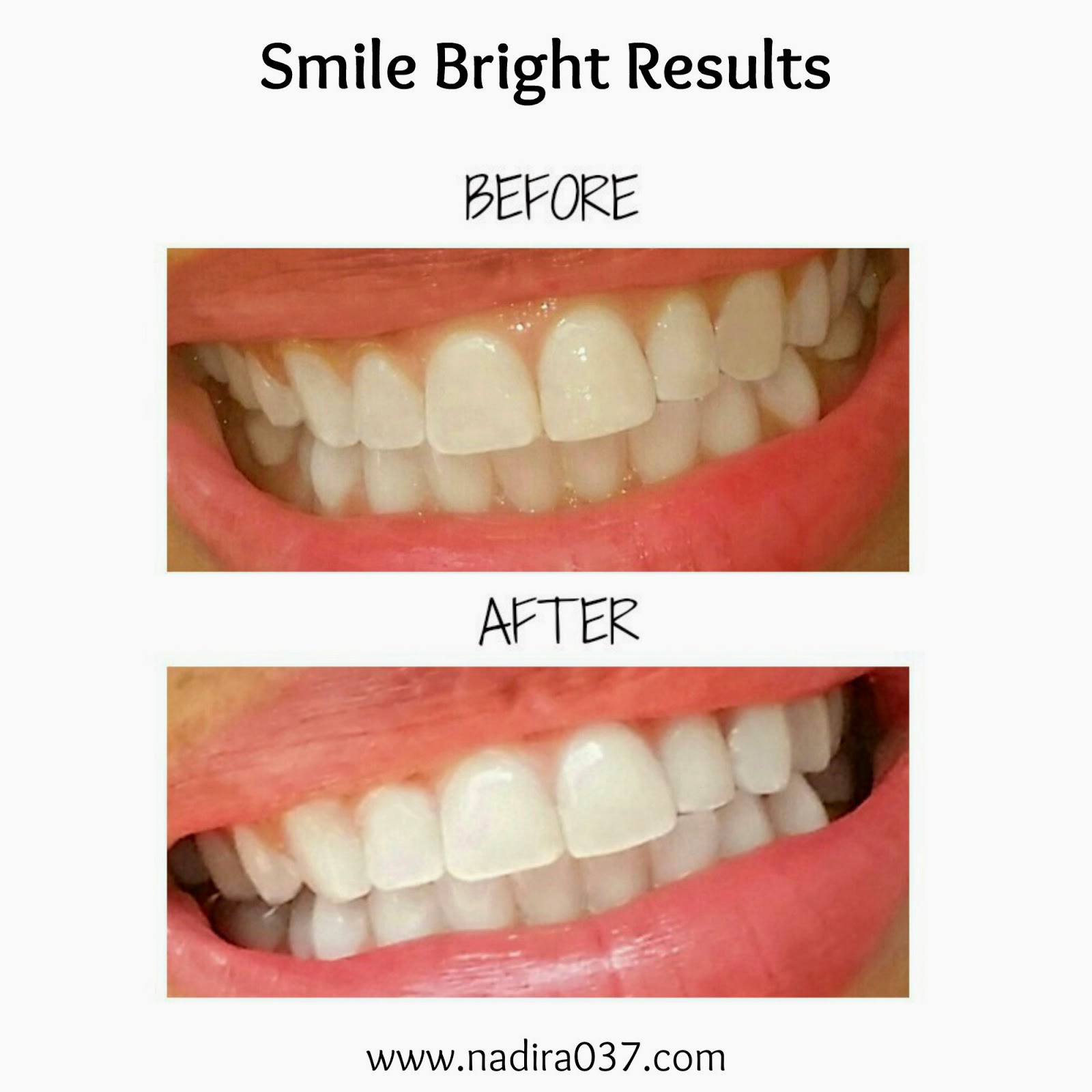 Diy Teeth Whitening Smile Bright Review Nadira037 within Teeth Whitening Diy