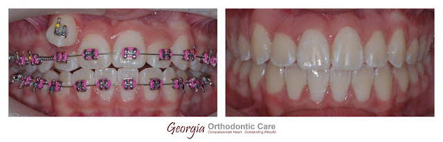 Incomplete transposed teeth, ectopic eruption, non extraction treatment, Orthodontics, orthodontists, Clear, Invisible, Braces, Invisalign, underbite,class III, face mask, non-surgery, non-extraction, crossbite, overbite, class II, crooked, spaced, crowding, teeth, severe, jaw alignment, cosmetics, implants, children, dentists, dentistry, friendly, adults, children, family, Lawrenceville, Norcross, Buford, Hamilton Mill, Dacula, Auburn, Sugar Hill, Sugar Loaf, Doraville, Chamblee, Stone Mountain, Decatur, Collins Hill, Snellville, Suwanee, Grayson, Lilburn, Duluth, Cumming, Alpharetta, Marietta, Dekalb, Gwinnett, County, Atlanta, North Georgia, GA, Georgia, 30043, 30093, affordable, Vietnamese, Spanish, weekend, Saturday, appointments, Dr. Quang Nguyen, Georgia Orthodontic Care, Nguyen Orthodontics.