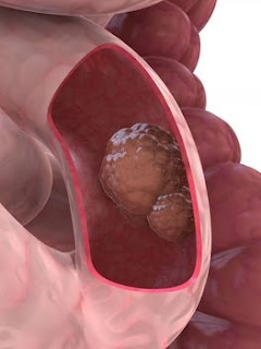 Colonoscopia complicaciones